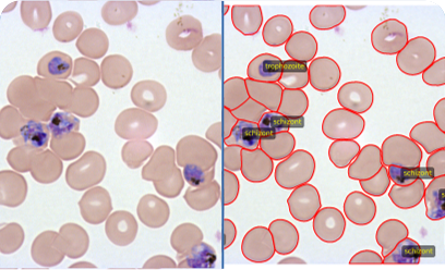 Malaria-Infected Cell Identification